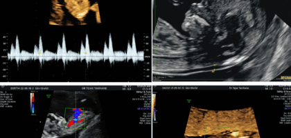 Nuchal translucency scan 11-13-6 weeks