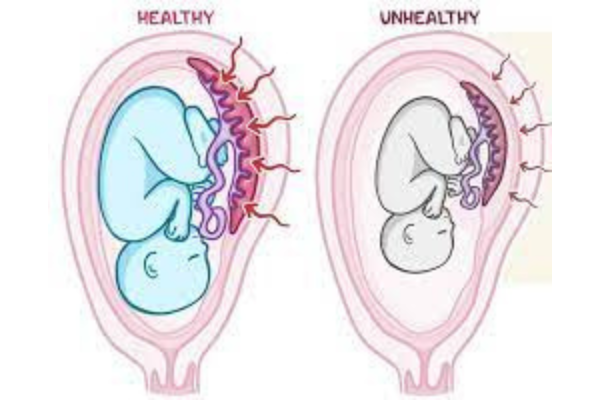 intrauterine growth restriction