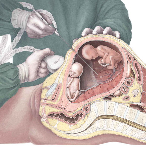 twin to twin transfusion syndrome in Pune