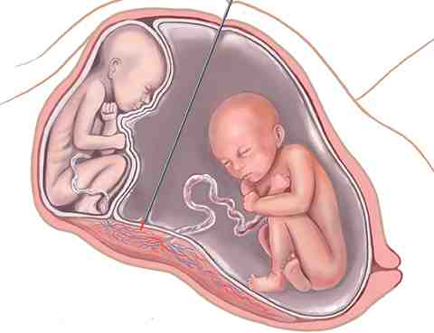 twin to twin transfusion syndrome in Pune