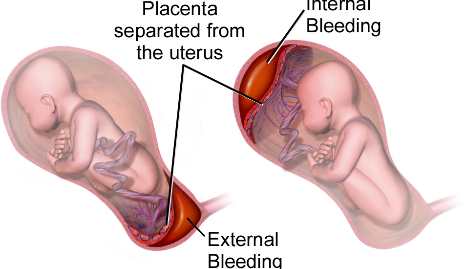 Managing Placental Abruption In Pune