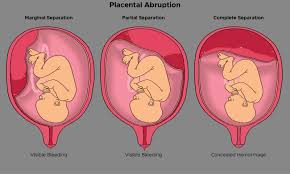 Managing Placental Abruption In Pune