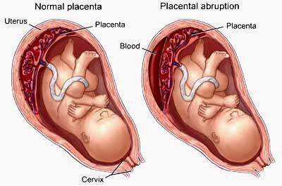 Managing Placental Abruption In Pune
