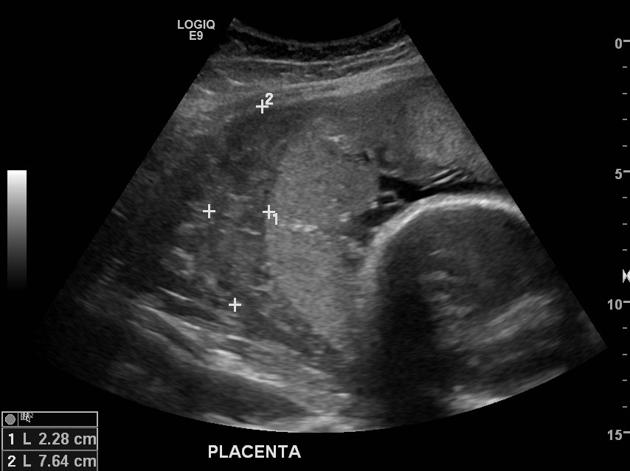 Managing Placental Abruption In Pune
