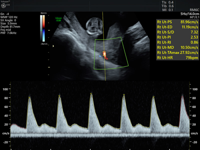 Preeclampsia Screening In Pune