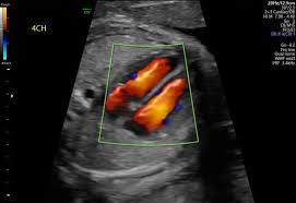 IVF Pregnancy Complications in Pune