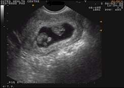 IVF Pregnancy Complications in Pune
