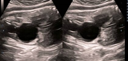 Treatment of Fetal Bladder Outlet Obstruction In Pune