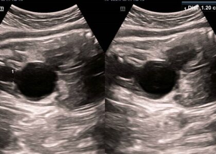 Treatment of Fetal Bladder Outlet Obstruction In Pune