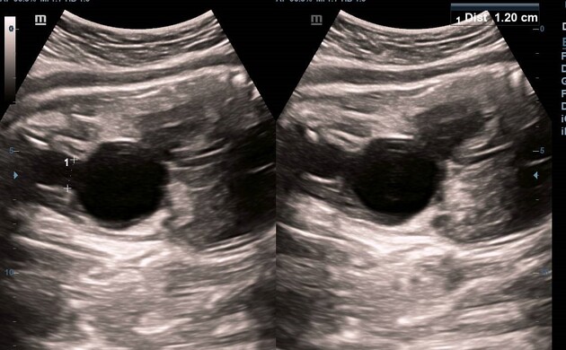 Treatment of Fetal Bladder Outlet Obstruction In Pune