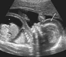 Fetal Pleural Effusion Treatment In Pune