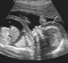 Fetal Pleural Effusion Treatment In Pune