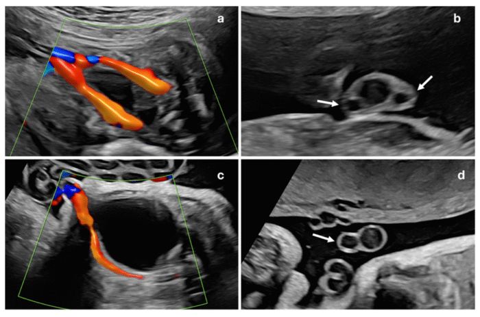 SUA In Pregnancy In Pune