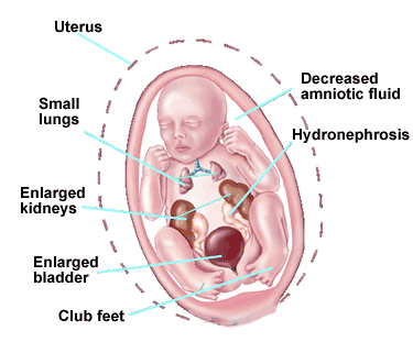 Treatment of Fetal Bladder Outlet Obstruction in Pune