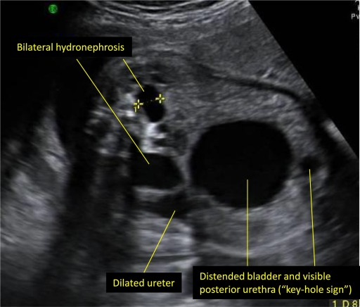 Treatment of Fetal Bladder Outlet Obstruction in Pune