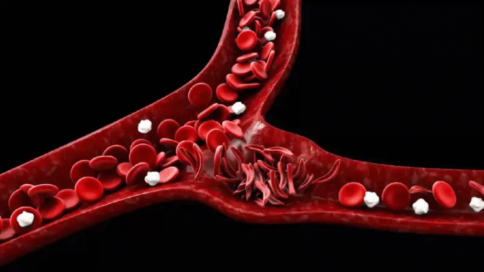Sickle Cell Testing During Pregnancy In Pune
