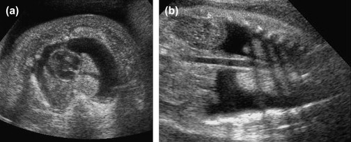 Fetal Pleural Effusion Treatment In Pune