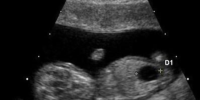 Fetal Megacystis Diagnosis In Pune