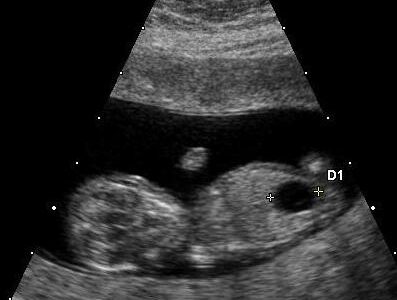 Fetal Megacystis Diagnosis In Pune