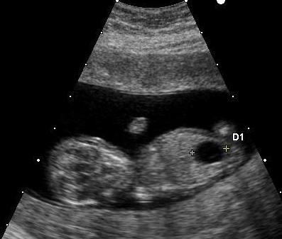 Fetal Megacystis Diagnosis In Pune