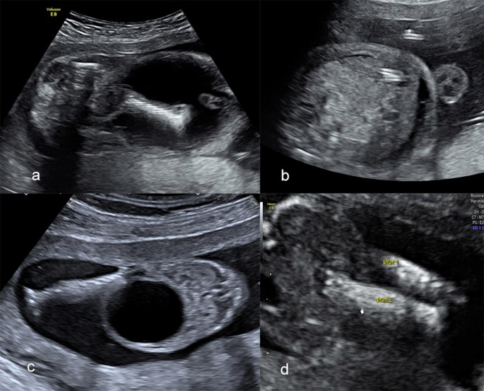 Fetal Megacystis Diagnosis In Pune
