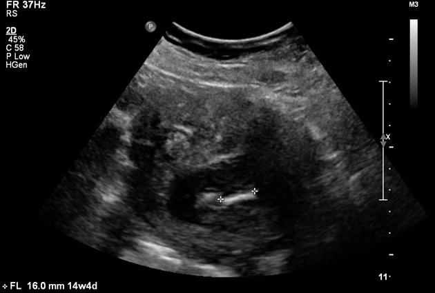 fetal megacystis diagnosis in Pune