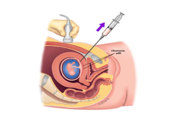 High-risk Pregnancy in Pune