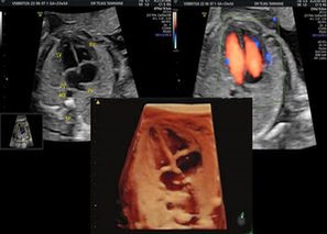 Fetal Echo Test In Pune