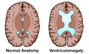 Fetal Brain Ventriculomegaly