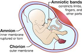 Amniotic Band Syndrome In The Fetus
