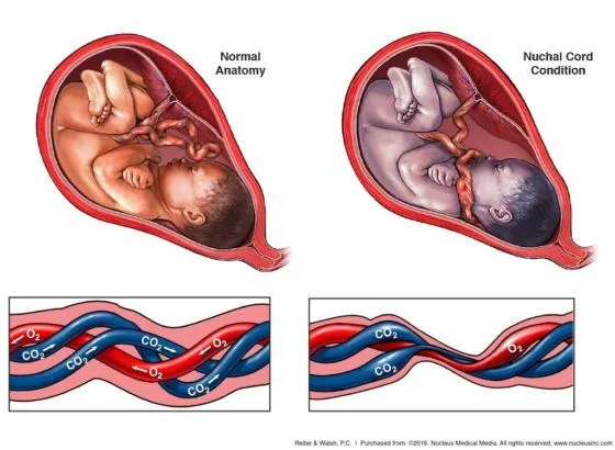 Nuchal Cords